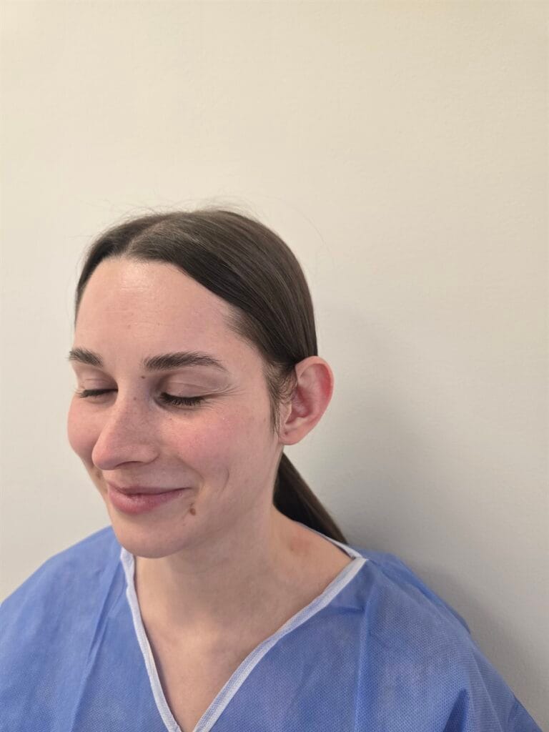 Cazul nr. 1 - Otoplastie - Oh