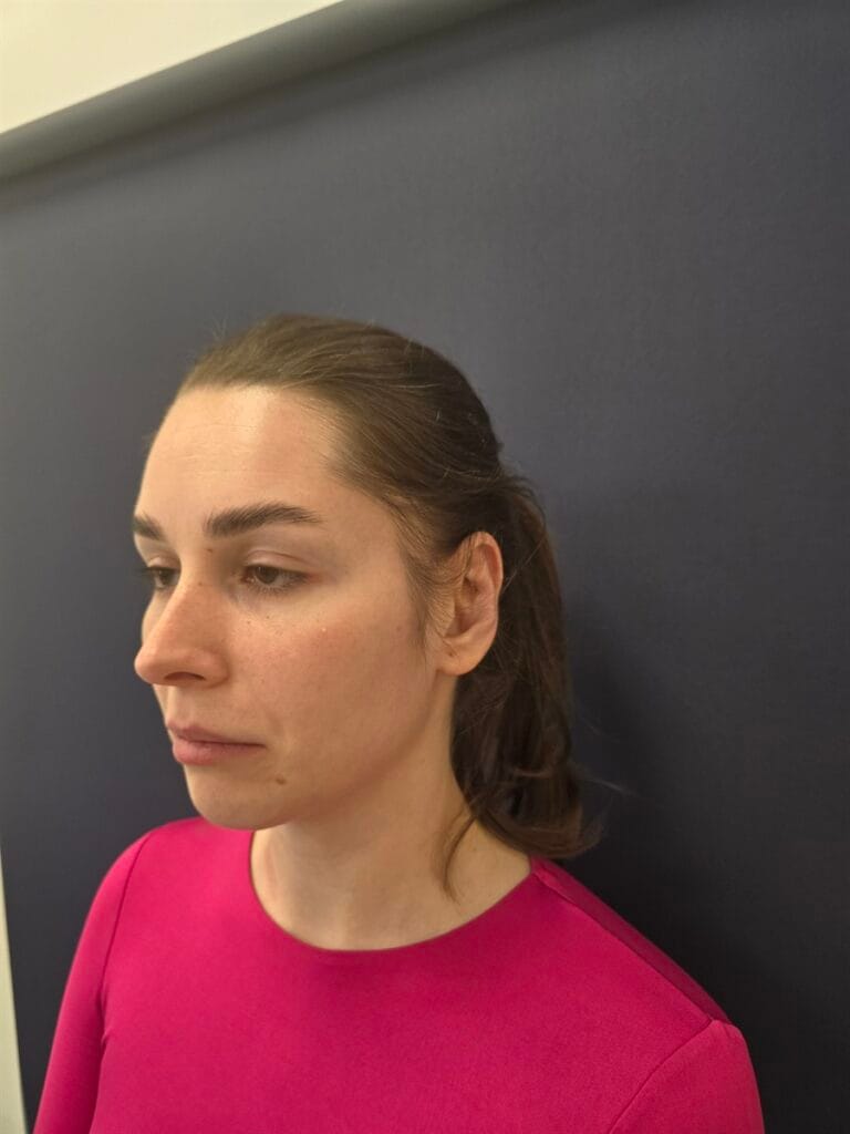 Cazul nr. 1 - Otoplastie - Oh