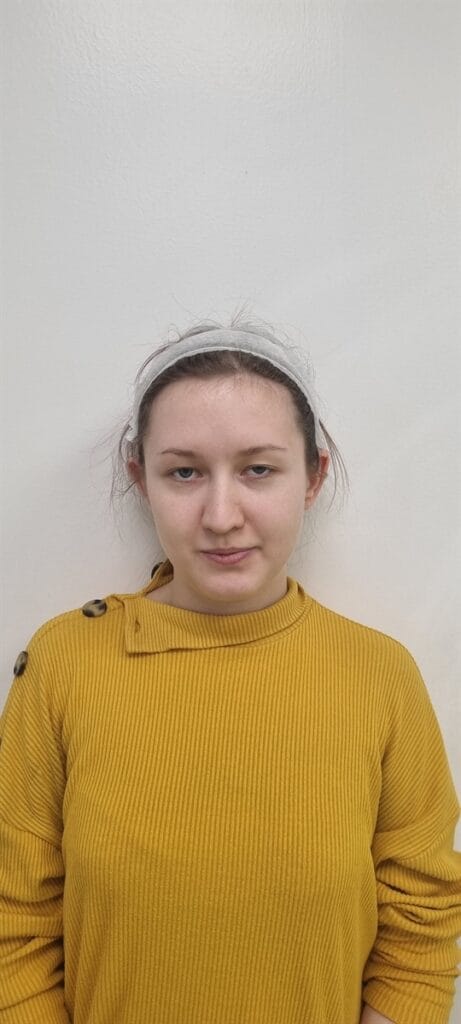 Cazul nr. 2 - Otoplastie - Oh