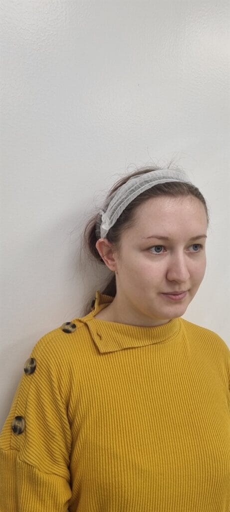 Cazul nr. 2 - Otoplastie - Oh