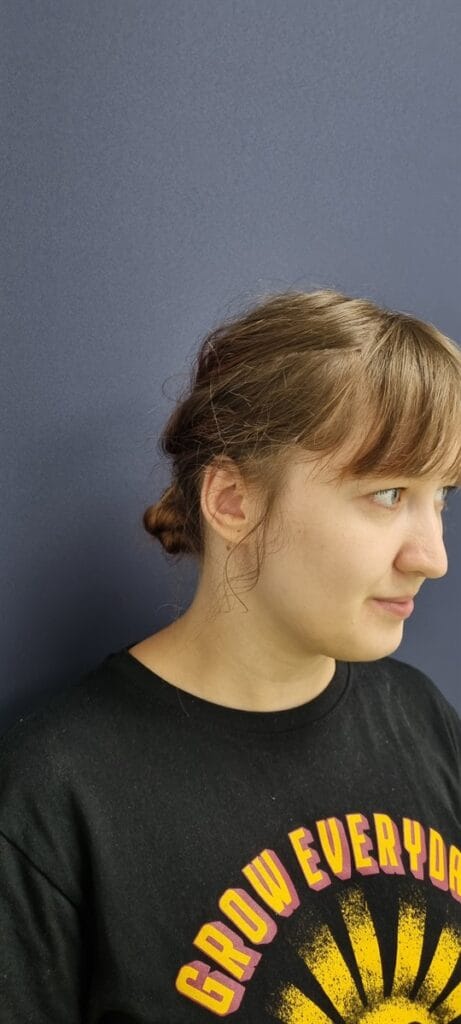 Cazul nr. 2 - Otoplastie - Oh