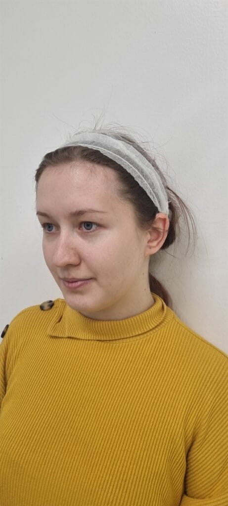 Cazul nr. 2 - Otoplastie - Oh