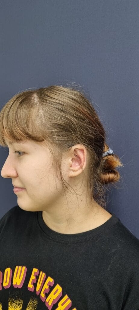 Cazul nr. 2 - Otoplastie - Oh