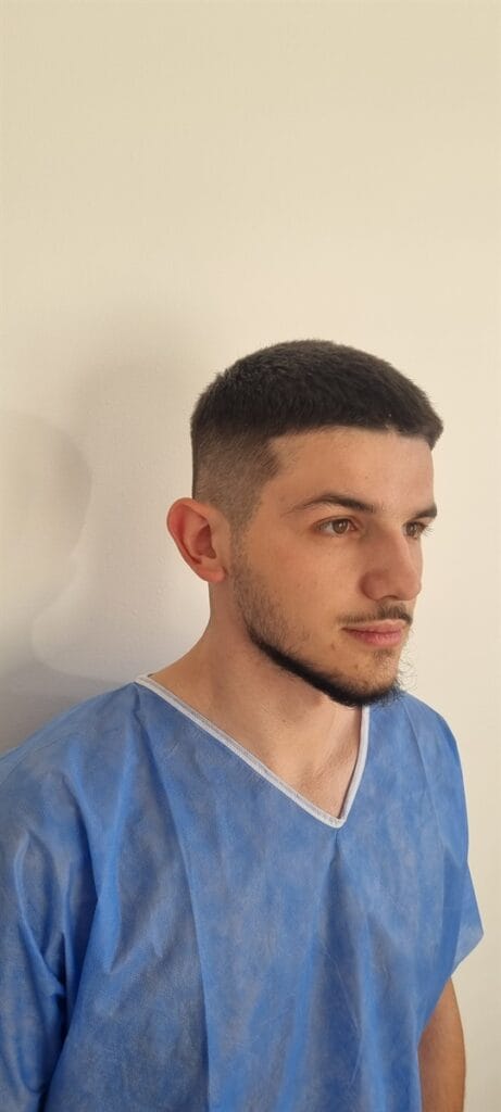 Cazul nr. 3 - Otoplastie - Oh