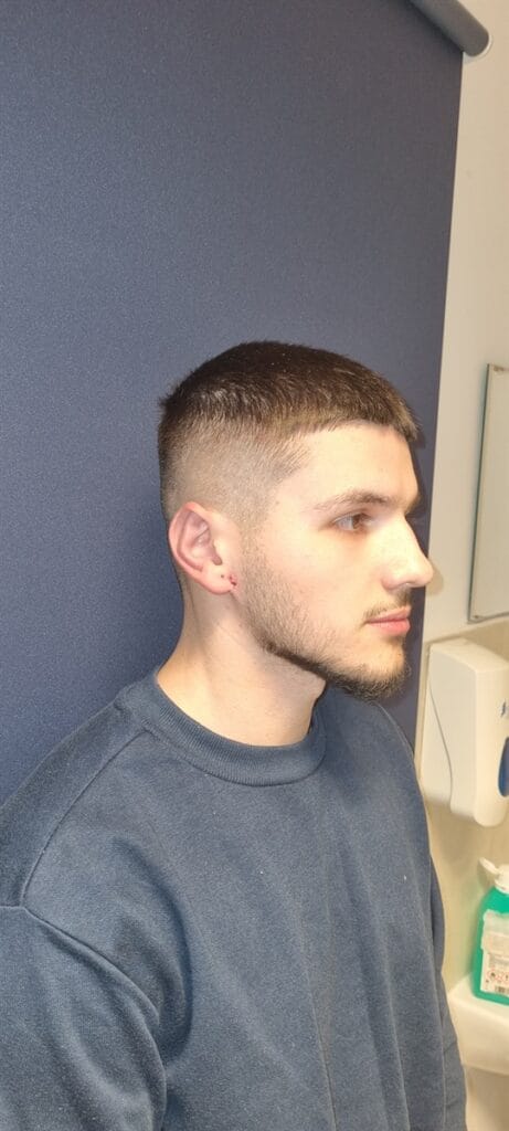 Cazul nr. 3 - Otoplastie - Oh