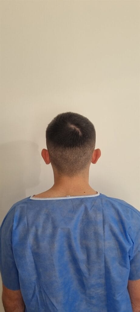 Cazul nr. 3 - Otoplastie - Oh