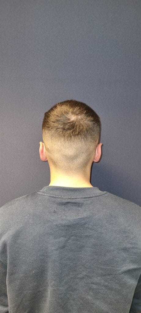 Cazul nr. 3 - Otoplastie - Oh