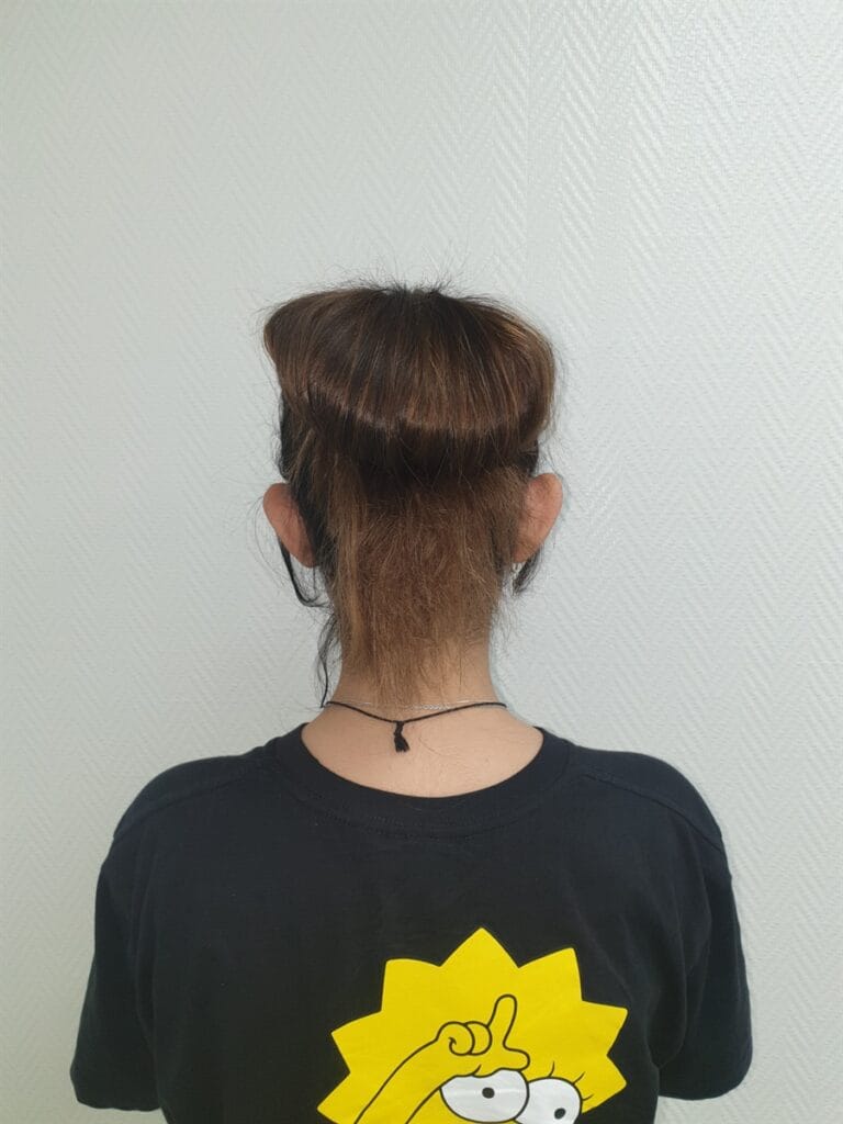 Gallery 558 Cazul nr. 4 - Otoplastie - Oh