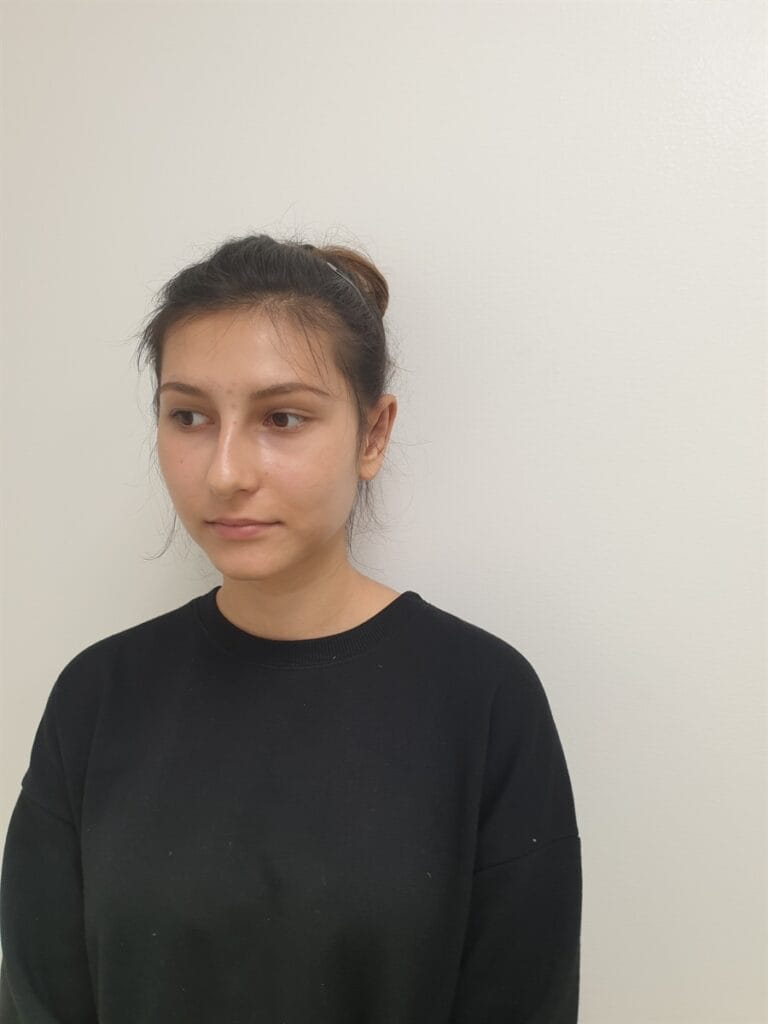 Gallery 561 Cazul nr. 4 - Otoplastie - Oh