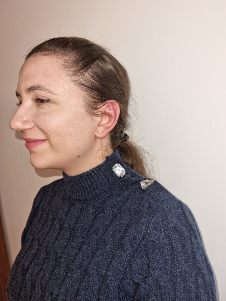 Gallery 565 Cazul nr. 5 - Otoplastie - Oh