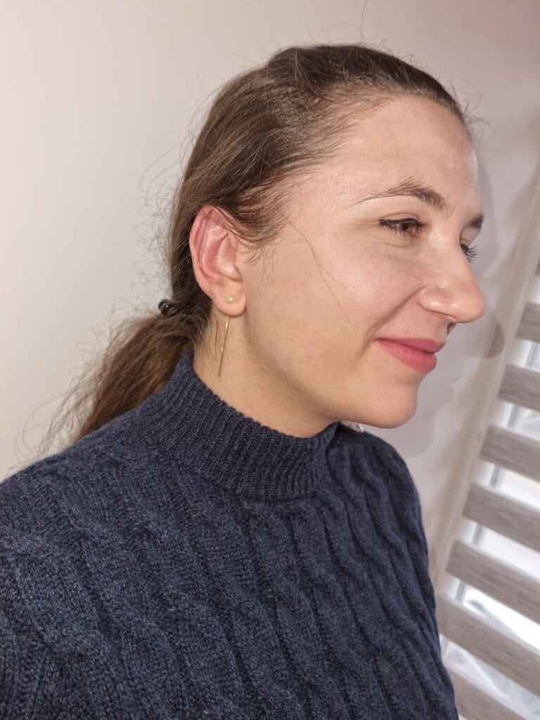 Gallery 567 Cazul nr. 5 - Otoplastie - Oh