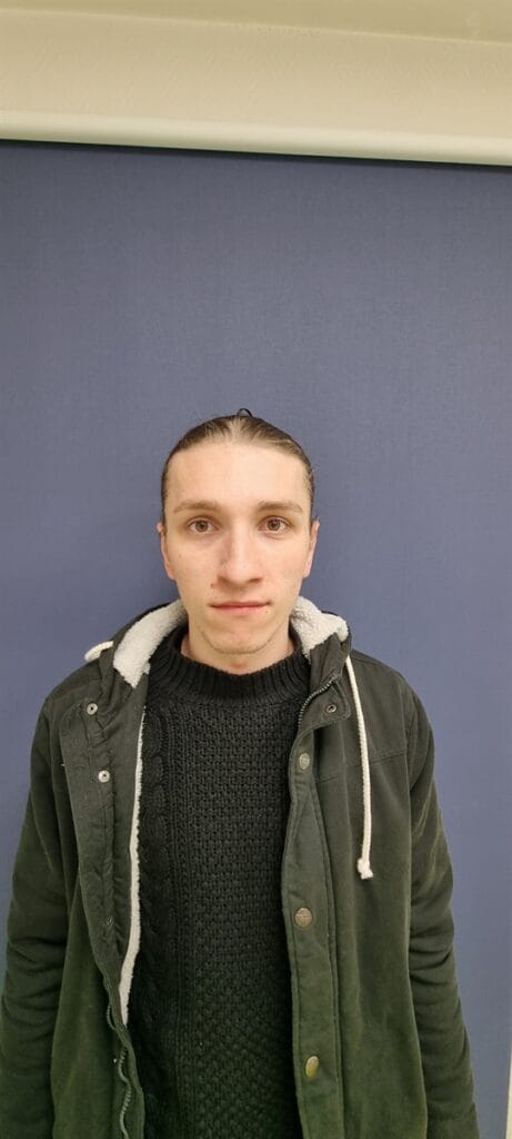 Gallery 569 Cazul nr. 6 - Otoplastie - Oh