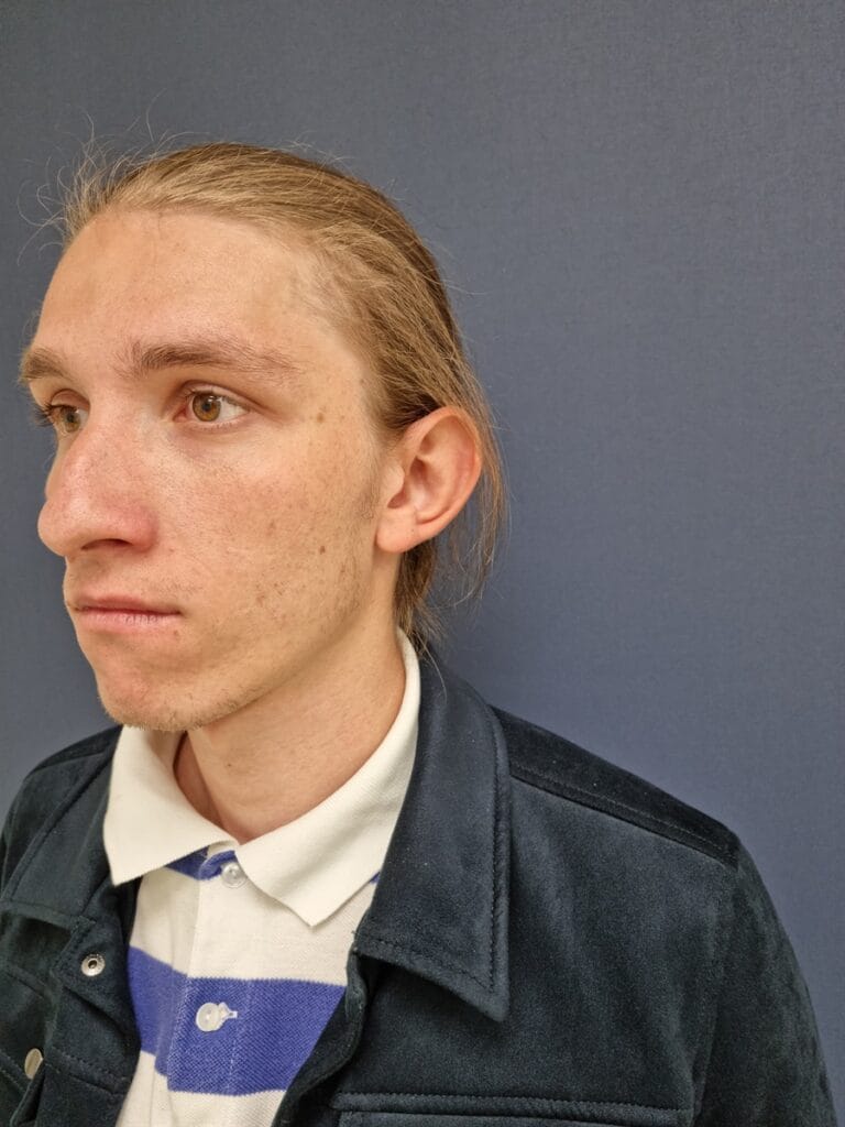 Gallery 570 Cazul nr. 6 - Otoplastie - Oh