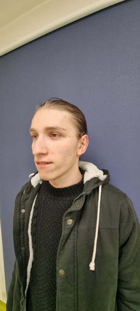 Gallery 571 Cazul nr. 6 - Otoplastie - Oh