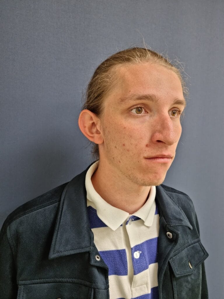 Gallery 572 Cazul nr. 6 - Otoplastie - Oh