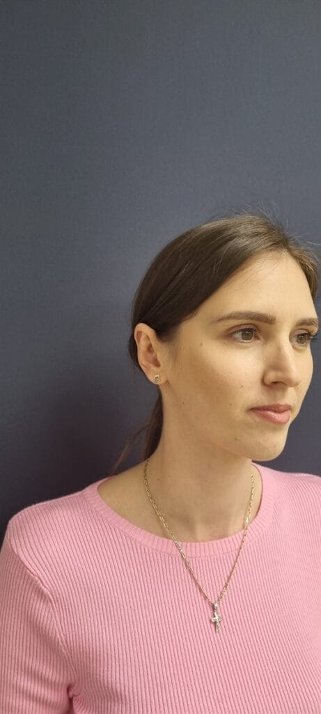 Gallery 577 Cazul nr. 7 - Otoplastie - Oh