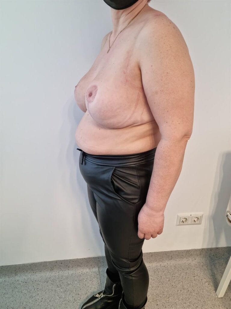 Gallery 585 Cazul nr. 1 - Reducție mamară - Oh