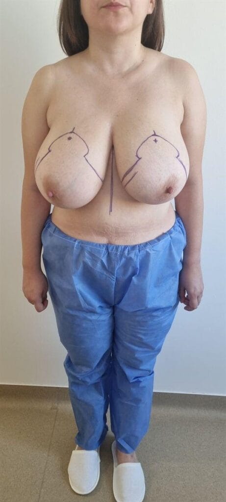 Gallery 586 Cazul nr. 2 - Reducție mamară - Oh