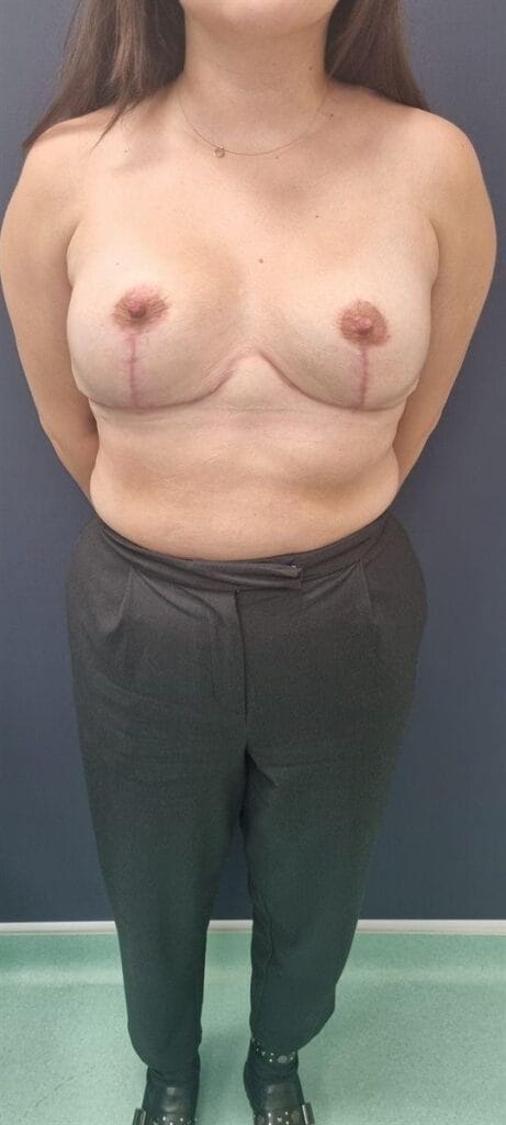 Gallery 587 Cazul nr. 2 - Reducție mamară - Oh