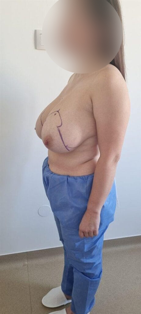Gallery 588 Cazul nr. 2 - Reducție mamară - Oh