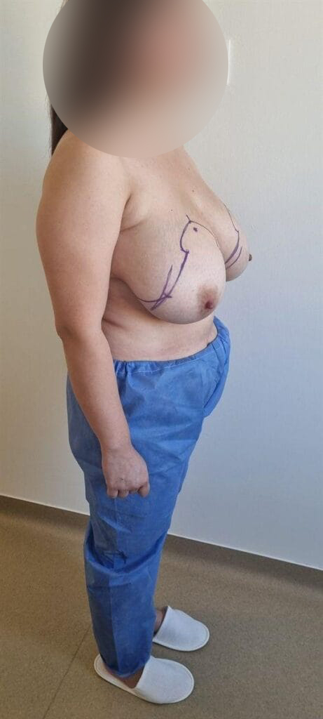 Gallery 590 Cazul nr. 2 - Reducție mamară - Oh