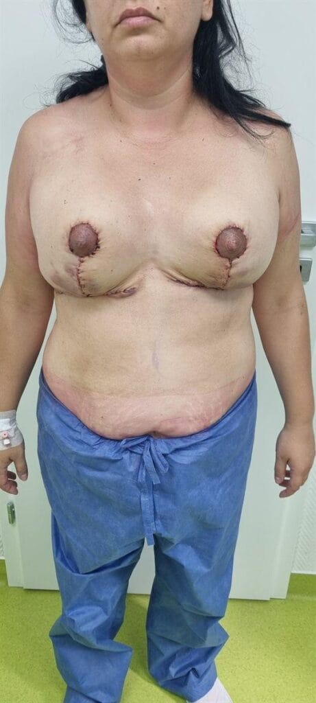 Gallery 593 Cazul nr. 3 - Reducție mamară - Oh