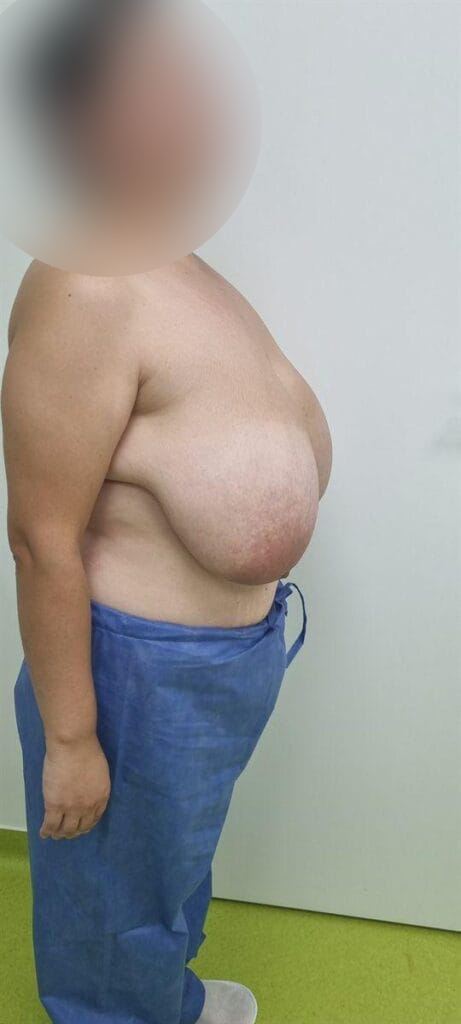 Gallery 594 Cazul nr. 3 - Reducție mamară - Oh