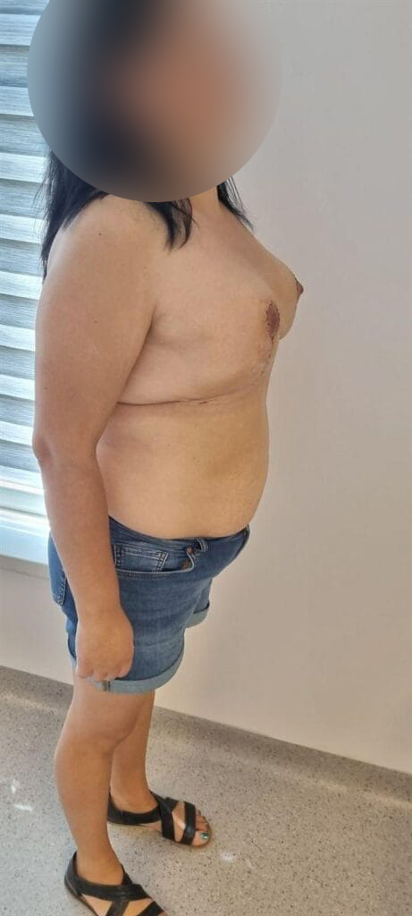 Gallery 595 Cazul nr. 3 - Reducție mamară - Oh