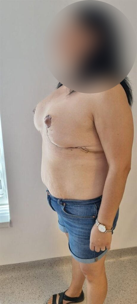 Gallery 597 Cazul nr. 3 - Reducție mamară - Oh