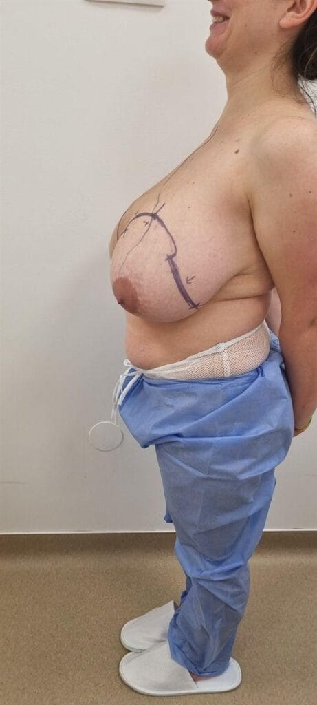 Gallery 600 Cazul nr. 4 - Reducție mamară - Oh