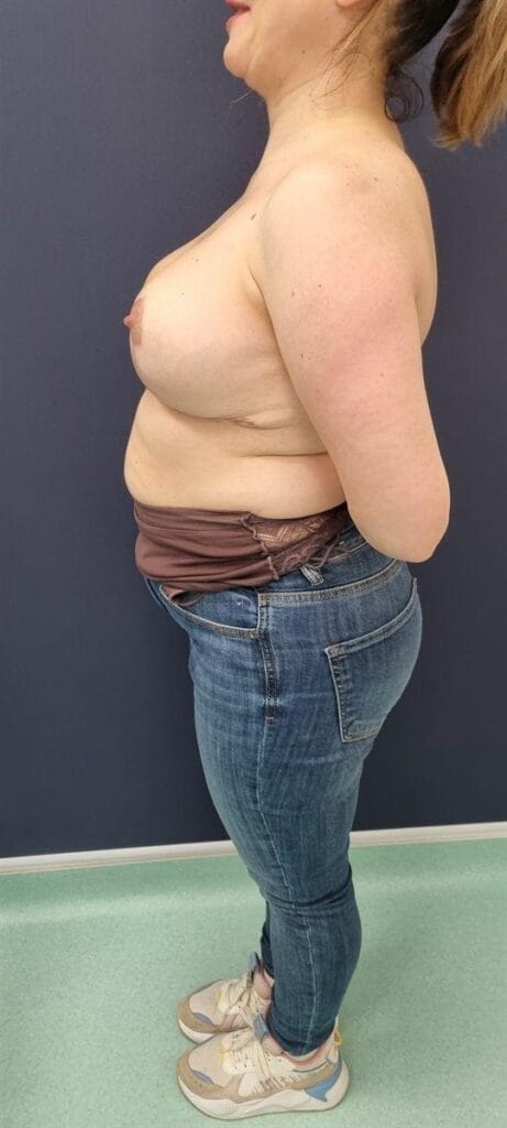 Gallery 601 Cazul nr. 4 - Reducție mamară - Oh