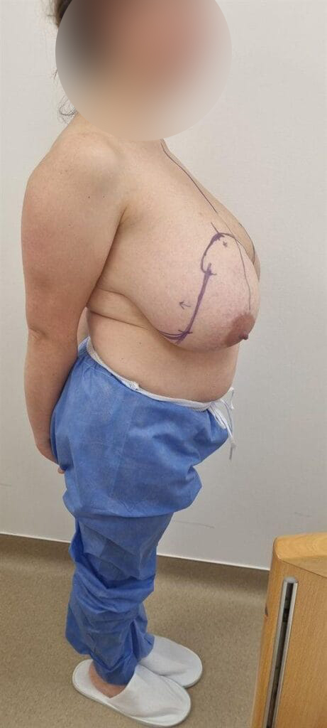 Gallery 602 Cazul nr. 4 - Reducție mamară - Oh