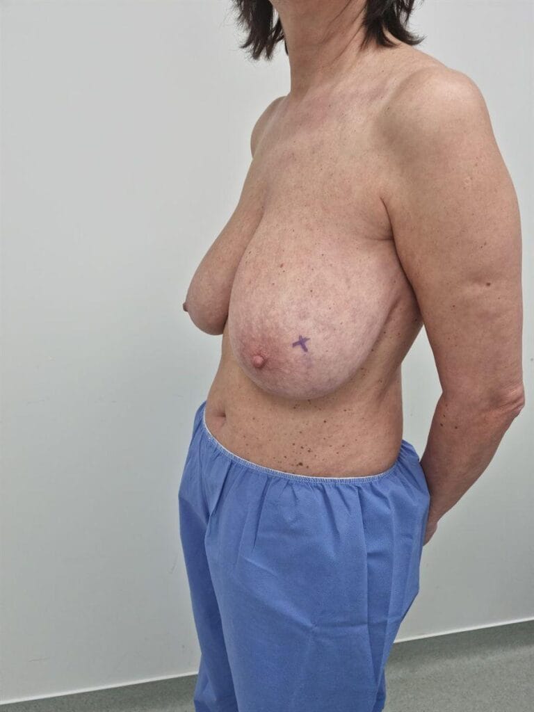 Gallery 608 Cazul nr. 5 - Reducție mamară - Oh