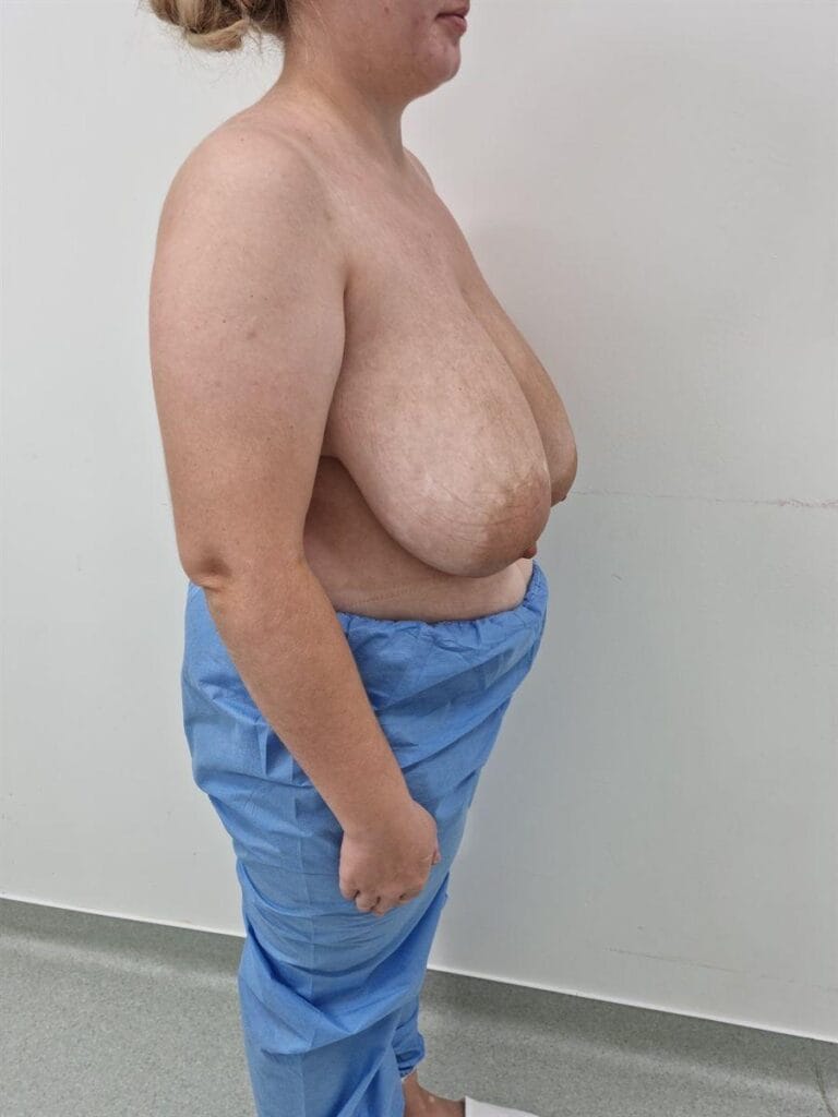 Gallery 612 Cazul nr. 6 - Reducție mamară - Oh