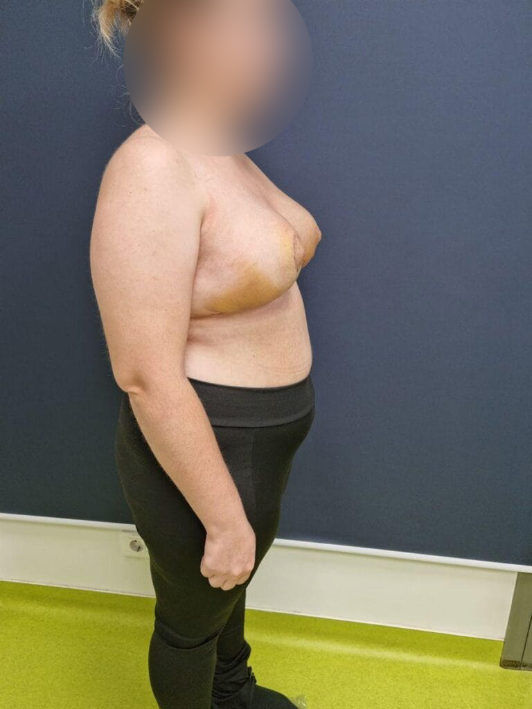 Gallery 613 Cazul nr. 6 - Reducție mamară - Oh