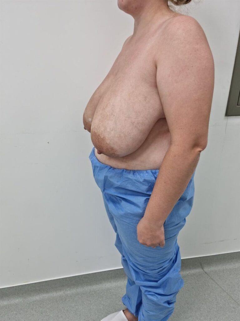 Gallery 614 Cazul nr. 6 - Reducție mamară - Oh